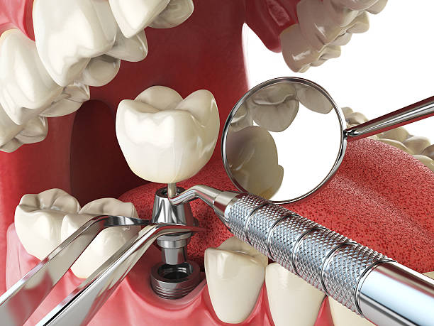 Best Emergency Root Canal Treatment in Gleed, WA